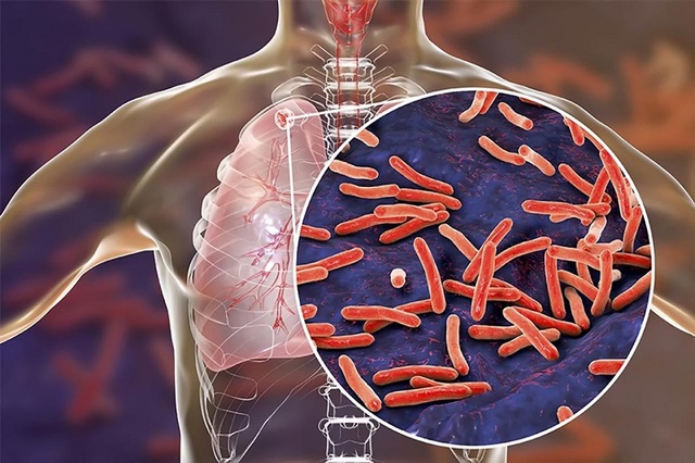 Ngăn chặn hiểm họa kép đồng nhiễm HIV/lao