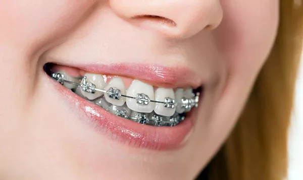 Niềng răng mắc cài kim loại tại Nha Khoa Sing - Giải pháp hoàn hảo cho nụ cười