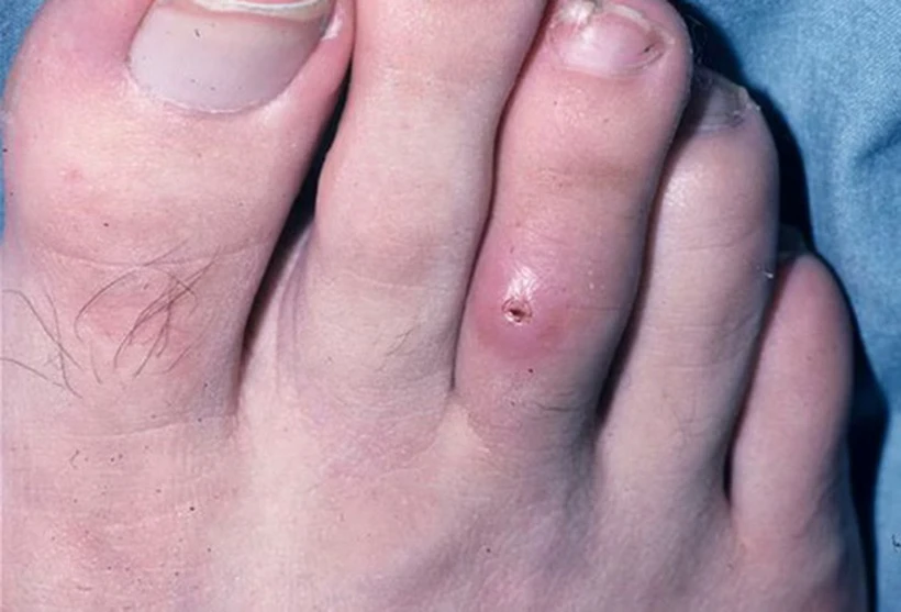 Vết thương do bệnh Myiasis. (Ảnh: medscape)