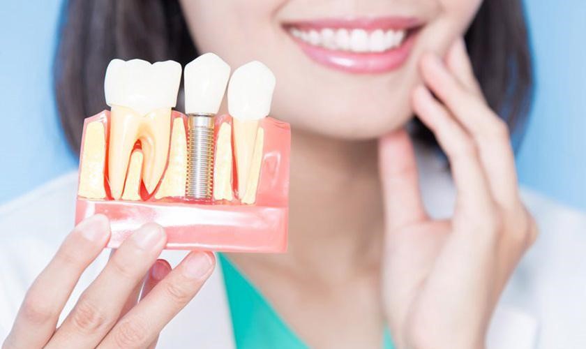 Có nên trồng Implant răng cửa không? Khám phá địa chỉ trồng răng uy tín