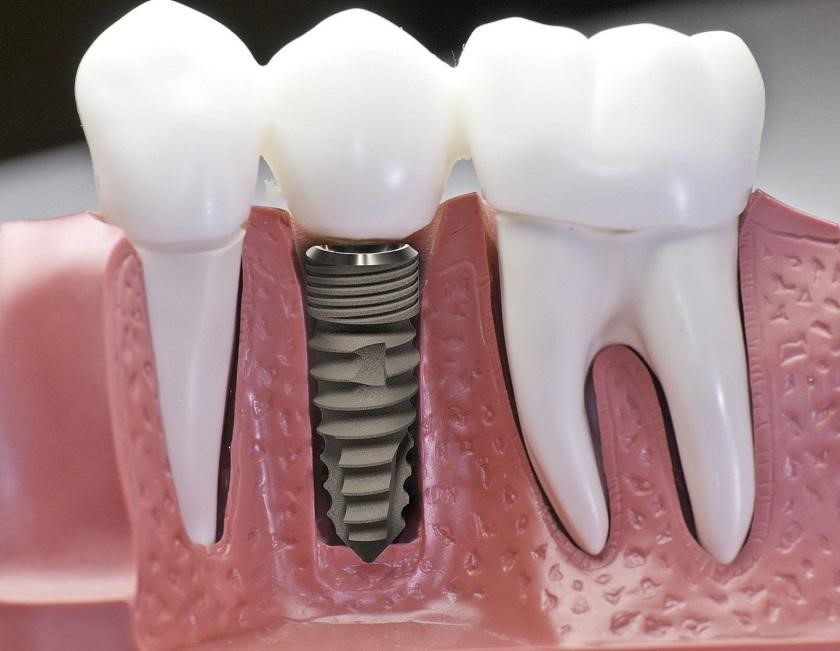  
Kỹ thuật trồng răng Implant an toàn, thẩm mỹ cao, hiệu quả lâu dài
