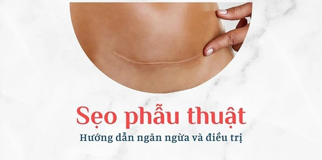 Làm thế nào để ngăn ngừa và điều trị sẹo sau phẫu thuật hiệu quả tại nhà?