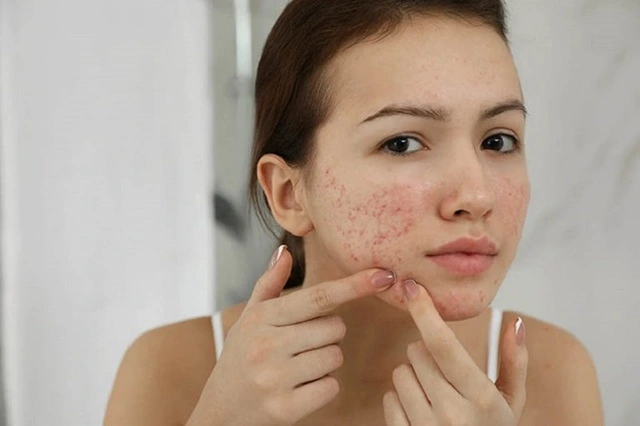 Thâm mụn liệu có đáng sợ như bạn nghĩ?